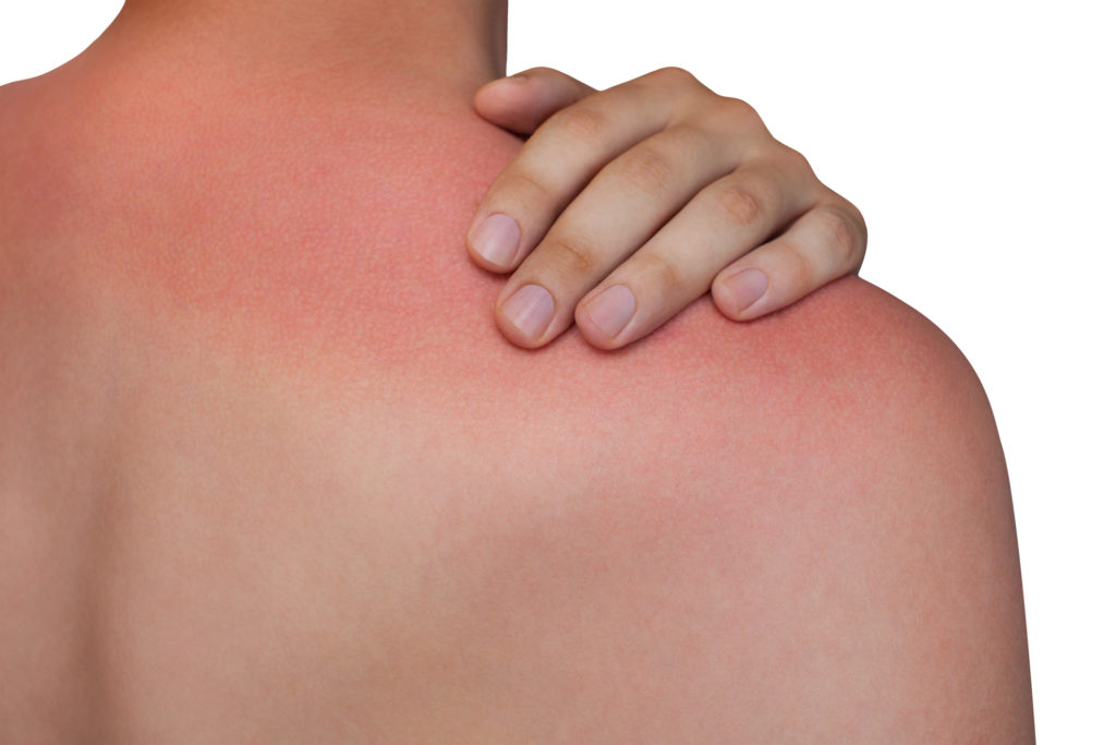 arsurile solare înroșirea inflamarea pielii
