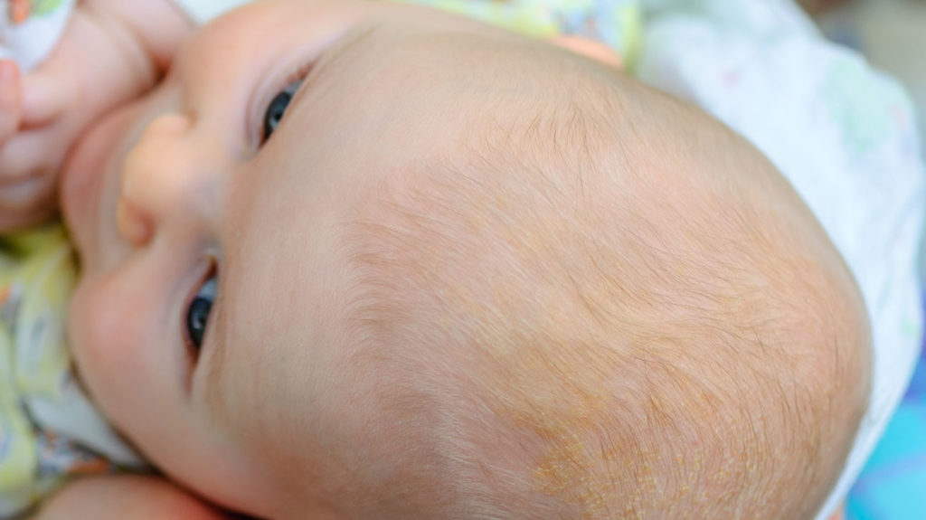 dermatita seboreică la bebeluși